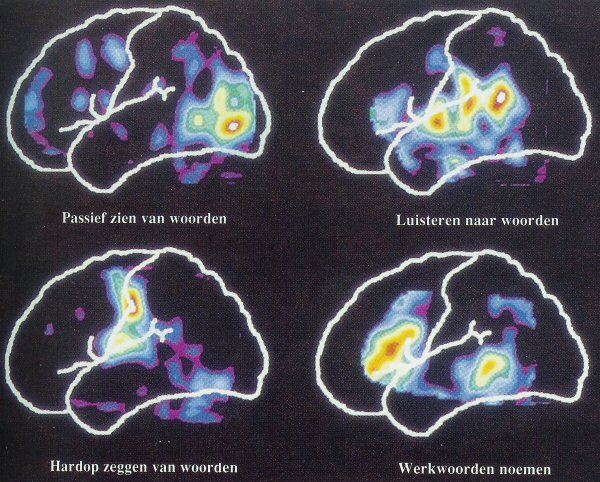 Figure 4. Pet scan showing brain regions involved in various language